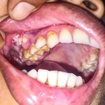 mouth cancer